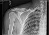 shoulder-01.JPG