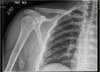 shoulder-01a.JPG