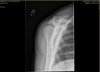shoulder-03.JPG