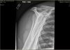 shoulder-03a.JPG